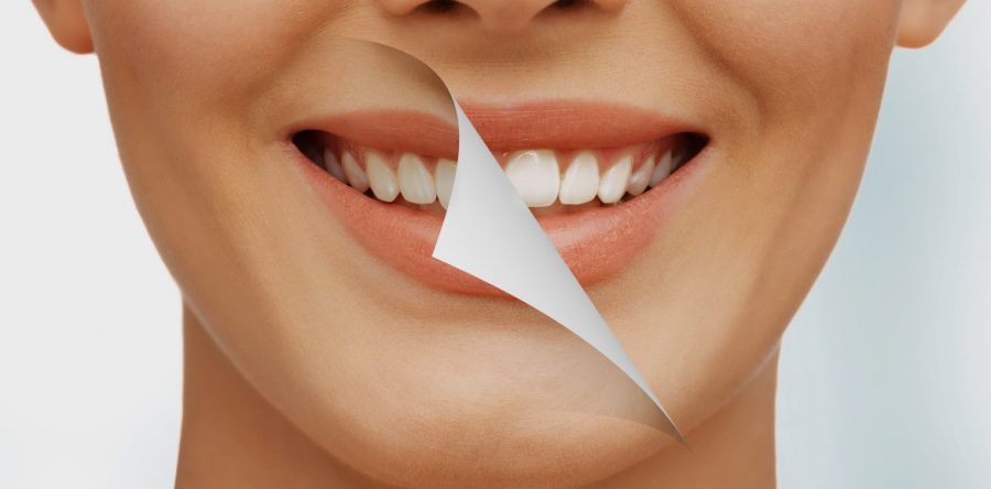 Teeth Whitening